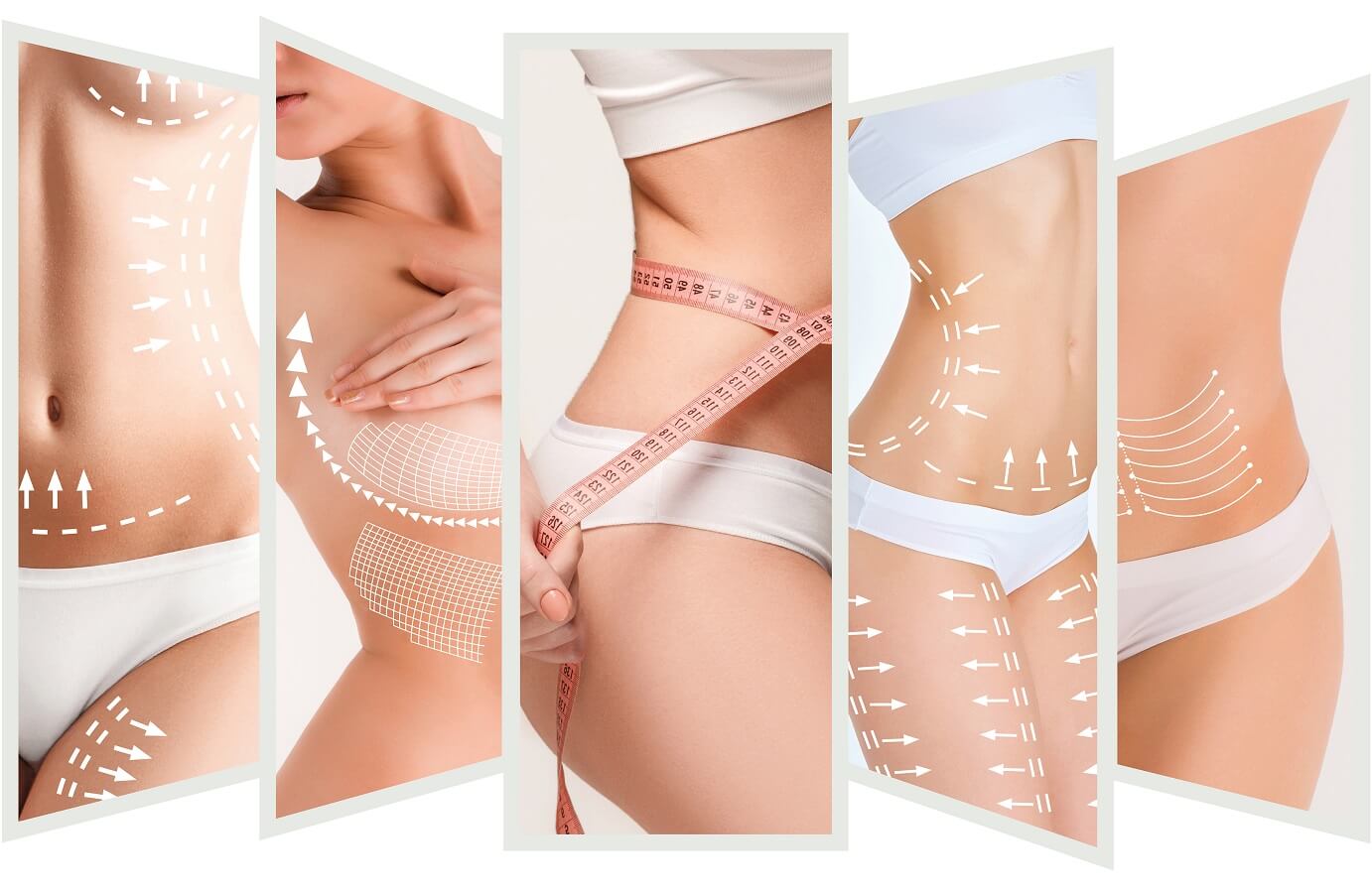 Pack 3 Sesiones HIFU corporal