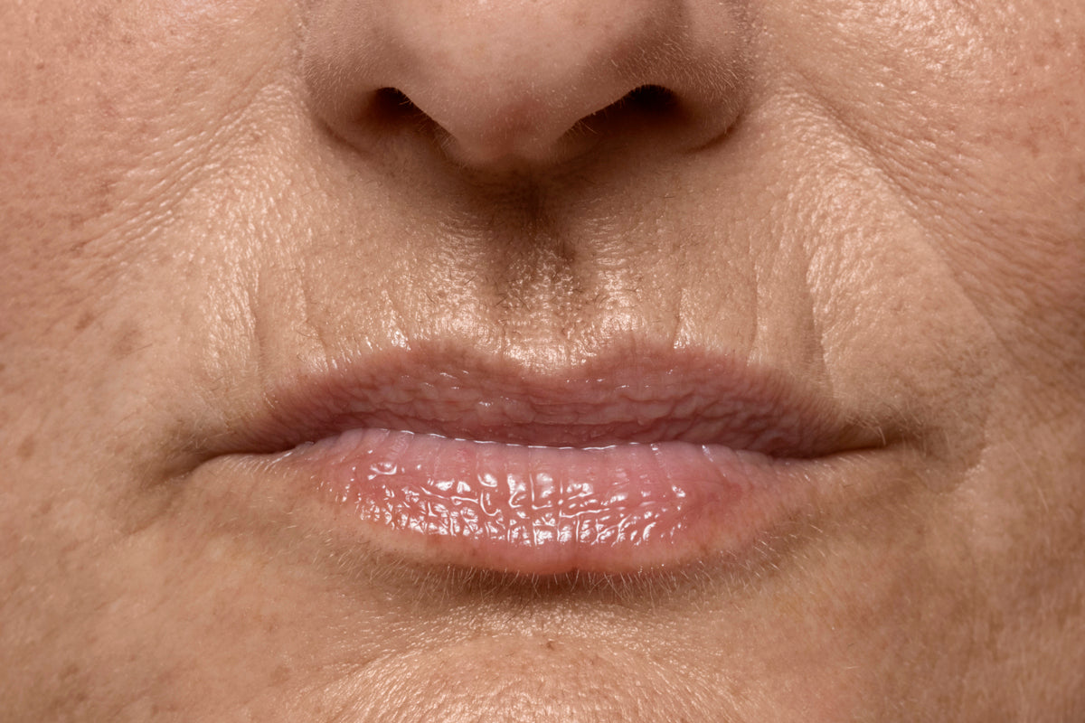 Lifting labial (Código de barra Upper lips)