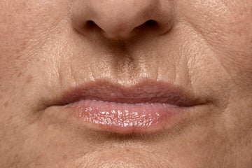 Lifting labial (Código de barra Upper lips)