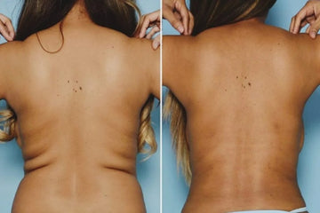Endolaser flancos y lipoaspiración