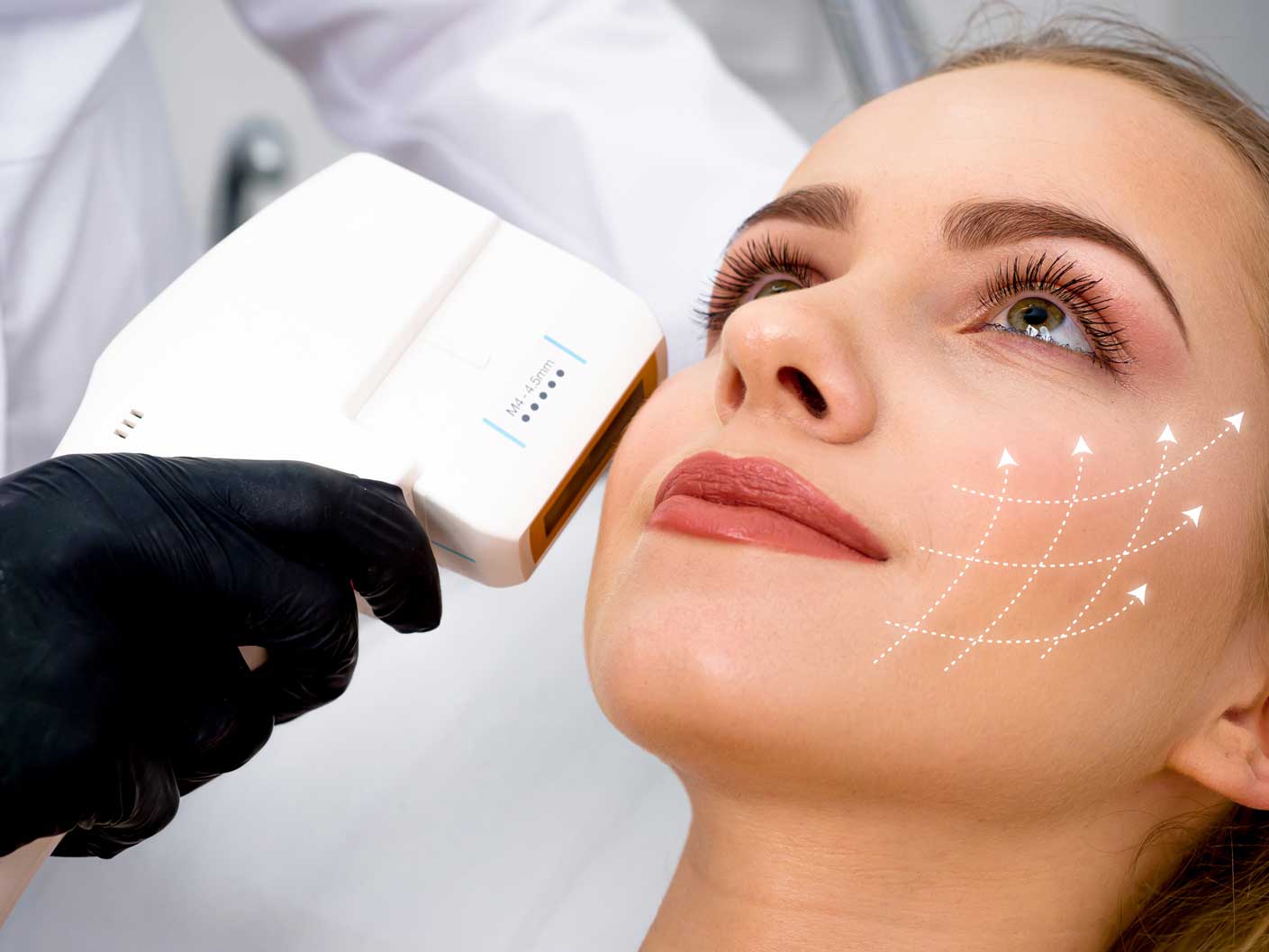 Pack 3 Sesiones HIFU Facial - Rostro y papada