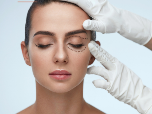 Asesoría Blefaroplastia