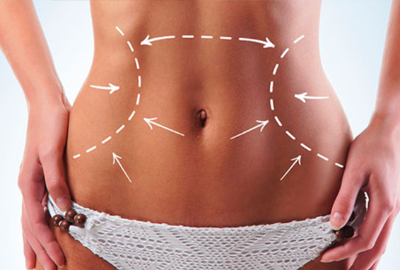 Lipoabdominoplastia