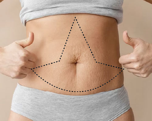 Lipoabdominoplastia en flor de Lis con injerto de grasa en zona glútea