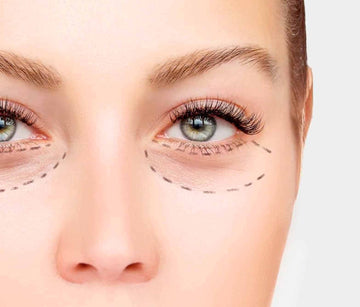 Relleno de Ojeras